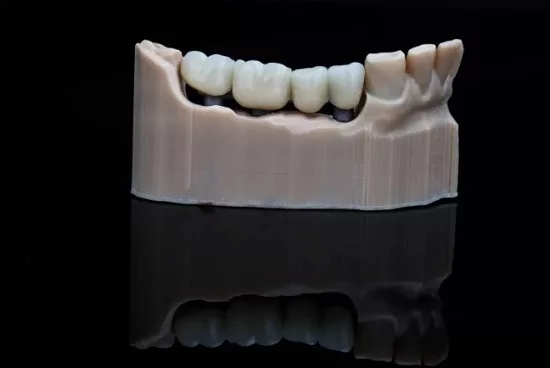 Протезирование зубов при потере нескольких зубов: как не ошибиться в выборе Протезирование зубов при потере нескольких зубов: как не ошибиться в выборе